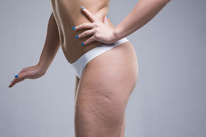 Exemple de cellulite et utilisation future de la cryothérapie pour s'en débarasser.